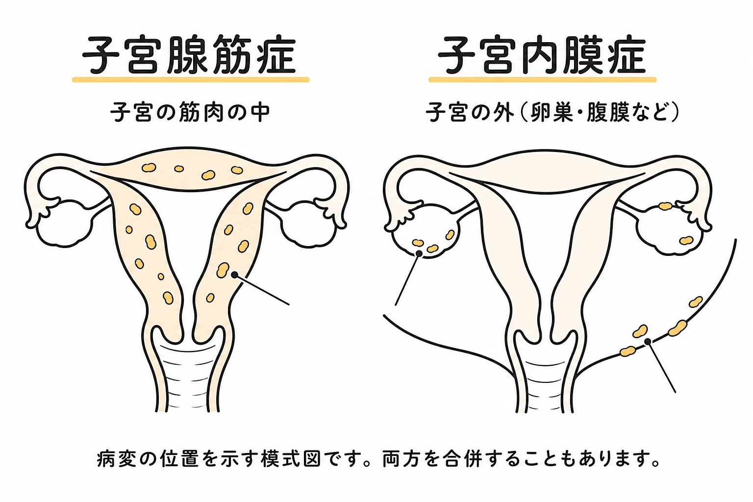 子宮腺筋症は子宮の筋肉の中、子宮内膜症は子宮の外に病変ができることを示す模式図