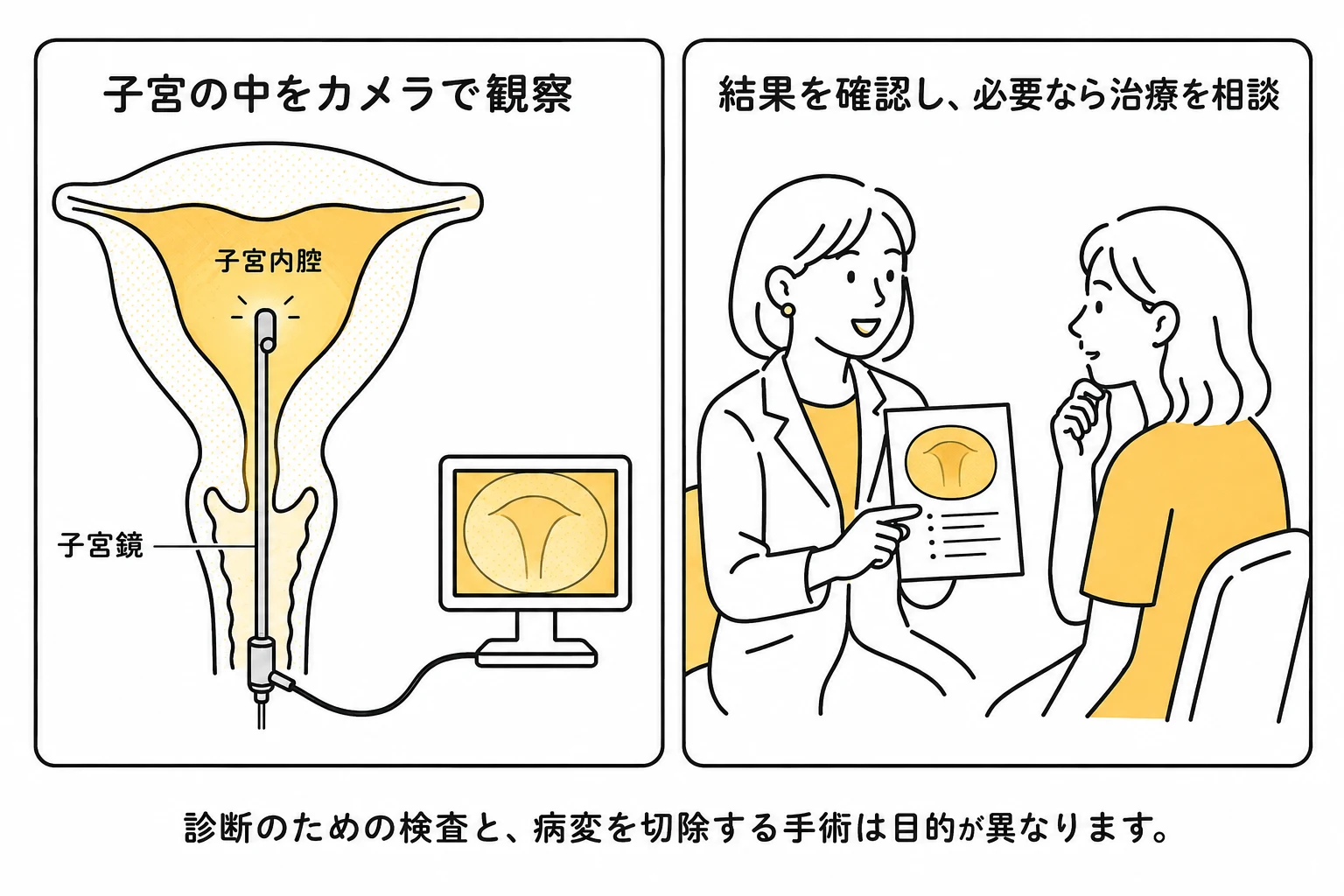 膣と子宮頸管を通して子宮鏡を入れ、子宮内腔を観察して結果を相談する模式図