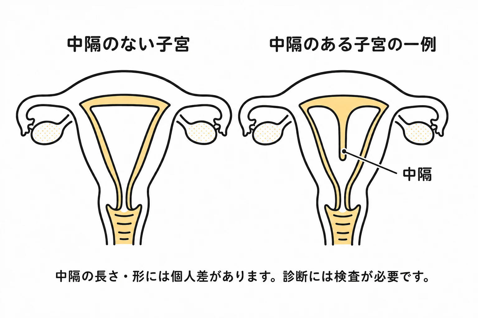 中隔のない子宮と、外側の形を保ったまま内腔に中隔がある子宮の一例